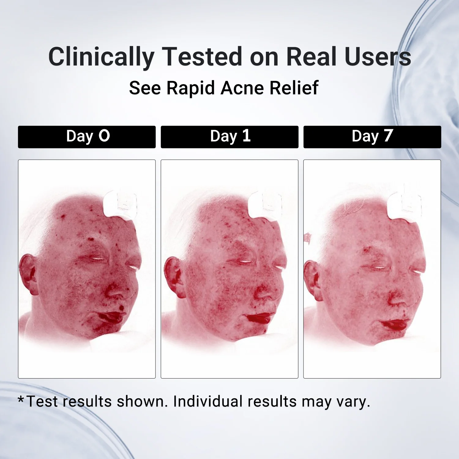 Acne Drying Lotion Plus — 3 Pack (20 mL × 3) - Image 7